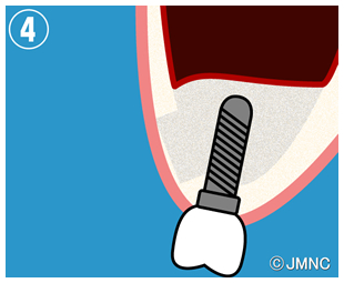 歯科のインプラントトラブル